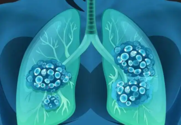 宏泰证券 奥希替尼联合方案治疗非小细胞肺癌取得突破